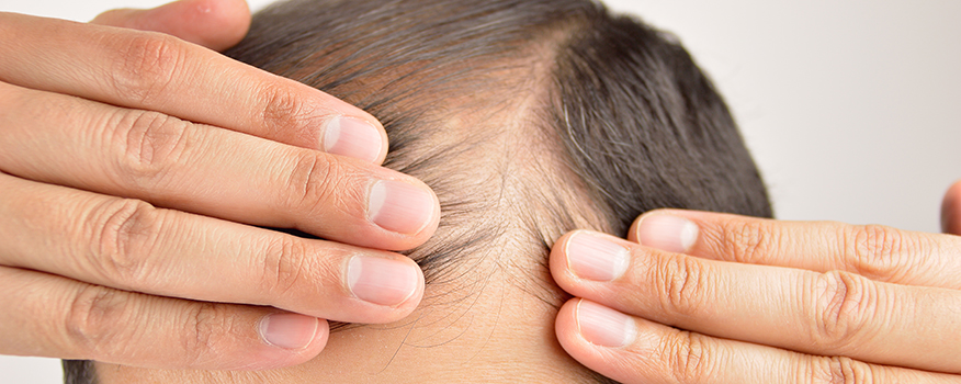 Hair Restoration Clearwater
