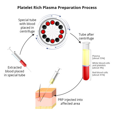PRP Therapy procedure
