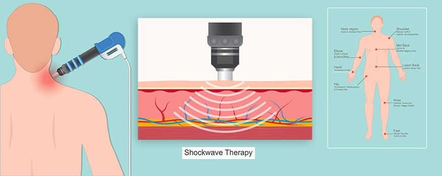 Shockwave therapy